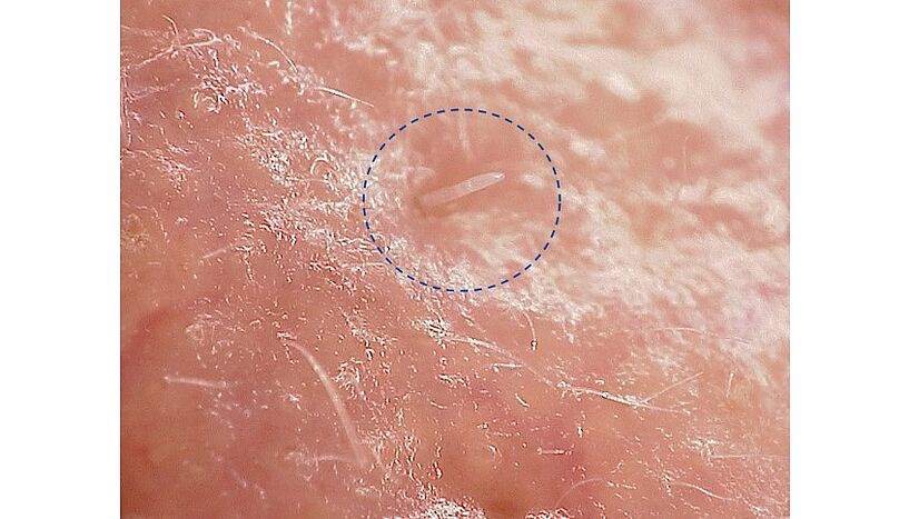 Mikroskopische Aufnahme einer in einer Hautpore steckenden Demodex folliculorum-Milbe