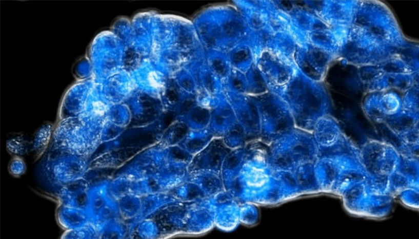Tumorgewebe blau eingefärbt